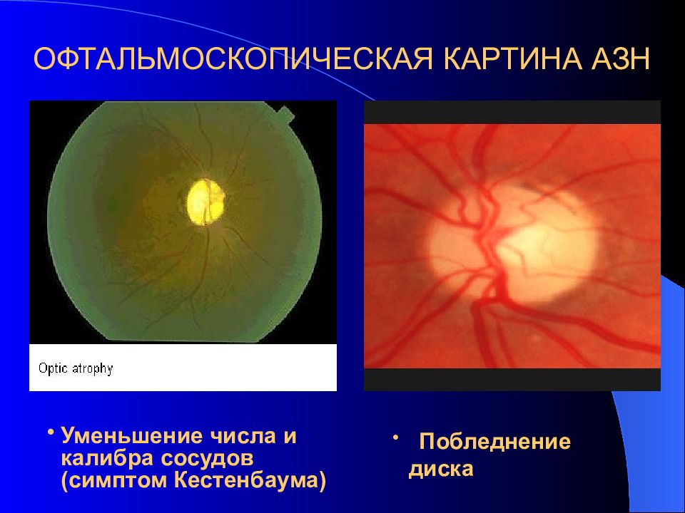 Заболевания зрительного нерва презентация