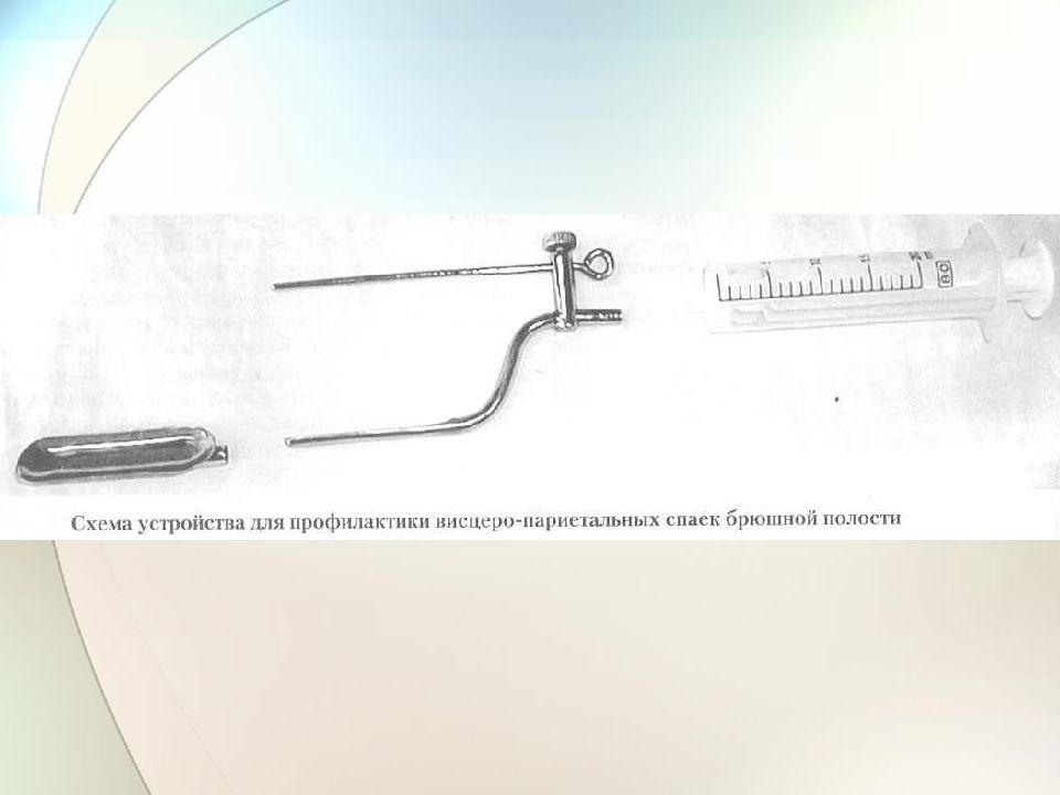 Мкб-10 спаечная болезнь брюшной полости. Спаечная болезнь брюшной полости код мкб 10. Фото ВМС установка внутри разрез.