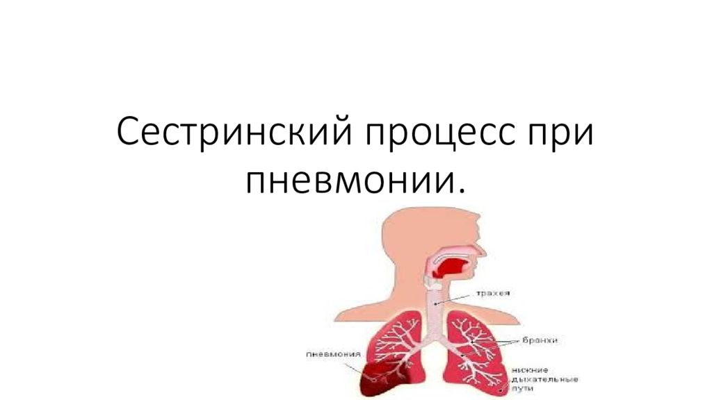 Сестринская при пневмониях. Сестринский процесс при пневмания. Сестринский процесс при острой пневмонии. Этапы сестринского процесса при пневмонии. Сестринский процесс при пневмонии у детей.