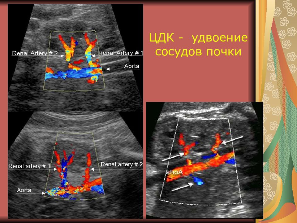 Фото удвоенной почки