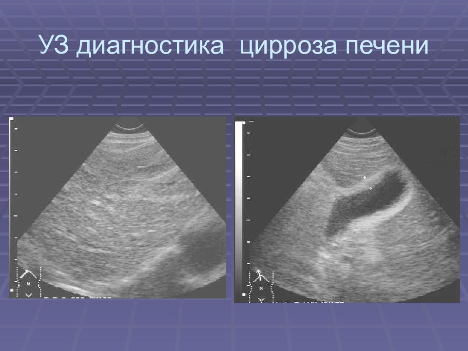 При классической картине цирроза в ультразвуковой картине печени