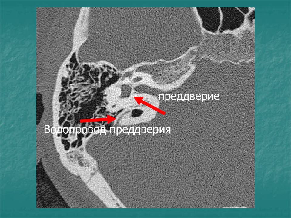 Пирамида височной кости кт