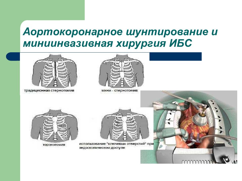 Аортокоронарное шунтирование. Миниинвазивное коронарное шунтирование. Малоинвазивное коронарное шунтирование. Шунтирование грудной клетки.