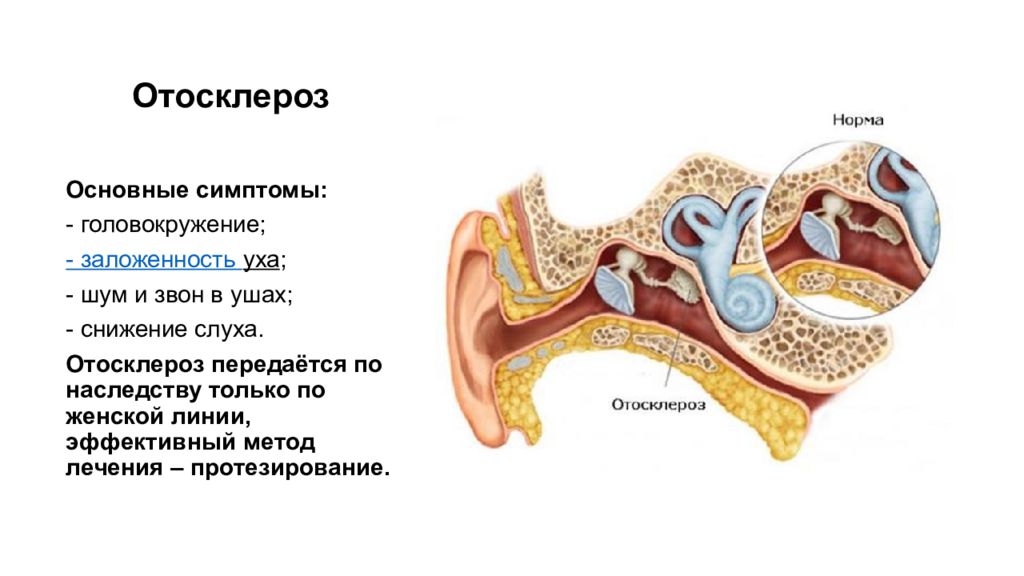 Отосклероз уха операция. Отосклероз стапедопластика. Отосклероз уха симптомы.