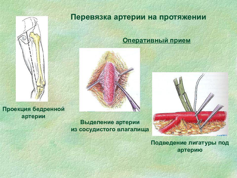 Презентация операции на сухожилиях