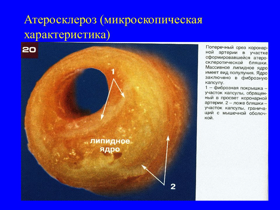 Микроскопические параметры. Липидное ядро атеросклеротической бляшки УЗИ. Атеросклероз характеристика. Микроскопическая характеристика атеросклероза. Атеросклероз микроскопический.