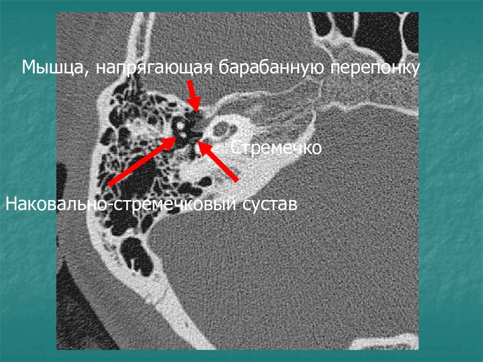 Мышца напрягающая барабанную. Барабанная перепонка на кт височных костей. Мышца напрягающая барабанную перепонку. Барабанная перепонка кт височной кости. Барабанная полость височной кости на кт.