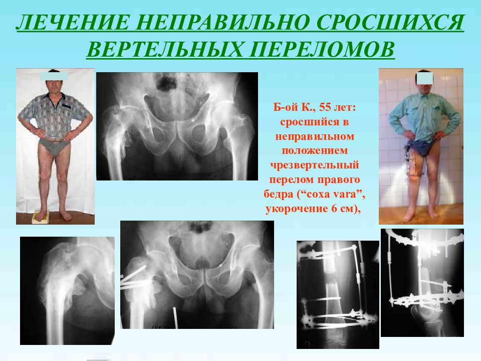 Неправильно сросшийся перелом. Причины неправильно сросшегося перелома. Осложнения вертельных переломов. Осложнения сращения переломов.