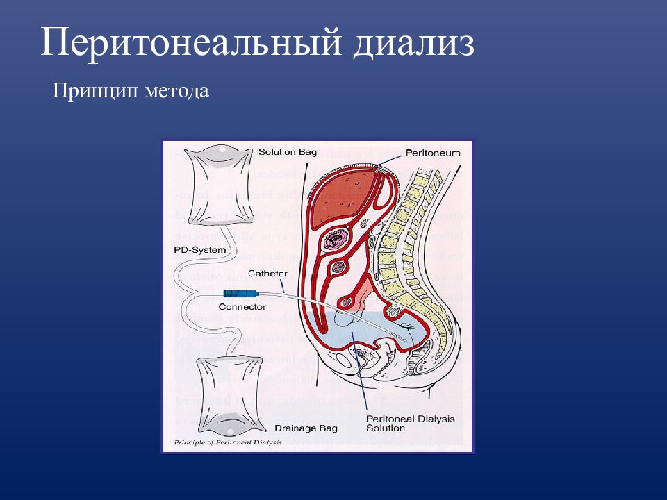 Перитонеальный диализ. Перитонеальный диализ принцип метода. Перитонеальный диализ клинические рекомендации. Схема перитонеального диализа. Методика проведения перитонеального диализа.