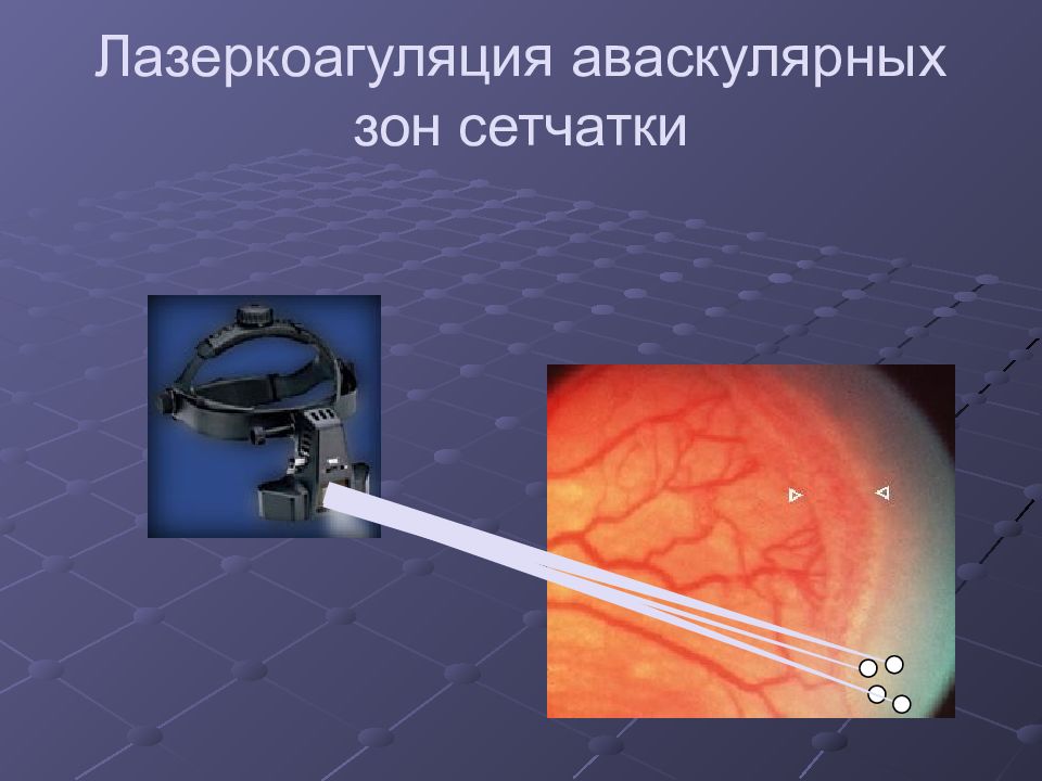 Что нельзя после коагуляции сетчатки глаза. Ретинопатия недоношенных лазеркоагуляция. Коагуляция аваскулярной сетчатки. Лазеркоагуляция сетчатки ретинопатии недоношенных. Зоны сетчатки при ретинопатии недоношенных.