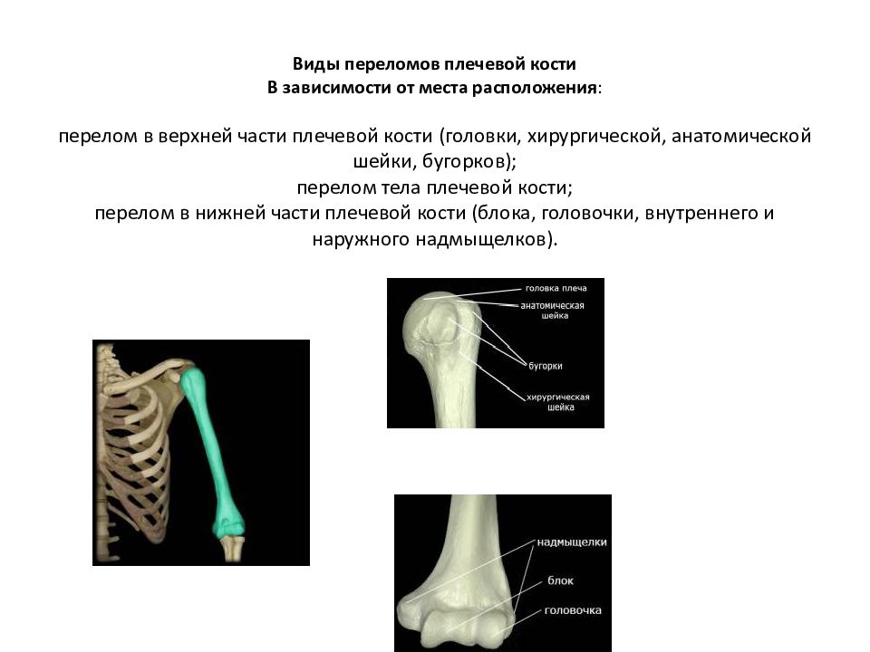 Переломы плечевой кости презентация