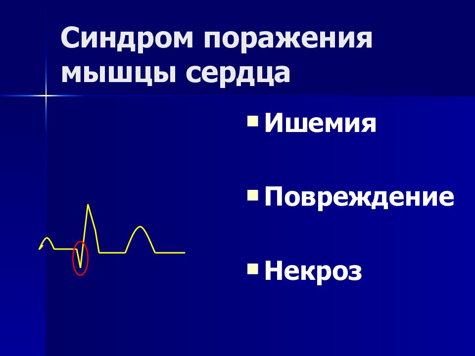 Синдром поражения мышц. Синдром поражения мышцы сердца. Синдром поражения сердечной мышцы. Синдром некроза сердечной мышцы ЭКГ