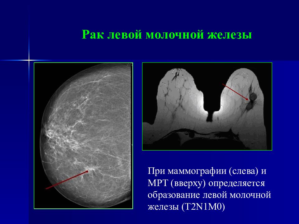В левой молочной. Лучевая диагностика в онкологии. Лучевая диагностика молочных желез презентация. С50.1 левой молочной железы.