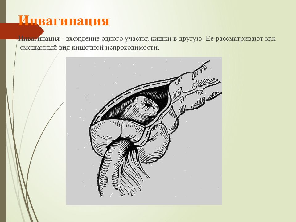 Острая кишечная непроходимость госпитальная хирургия презентация