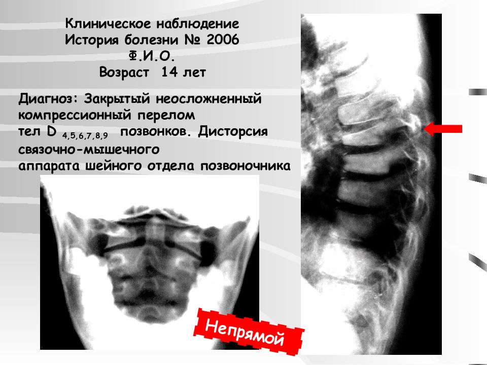Дисторсия шейного. Дисторсия шейного отдела позвоночника рентген. Перелом позвоночника формулировка диагноза. Дисторзия шейного отдела позвоночника. Дисторсии позвоночника рентген.