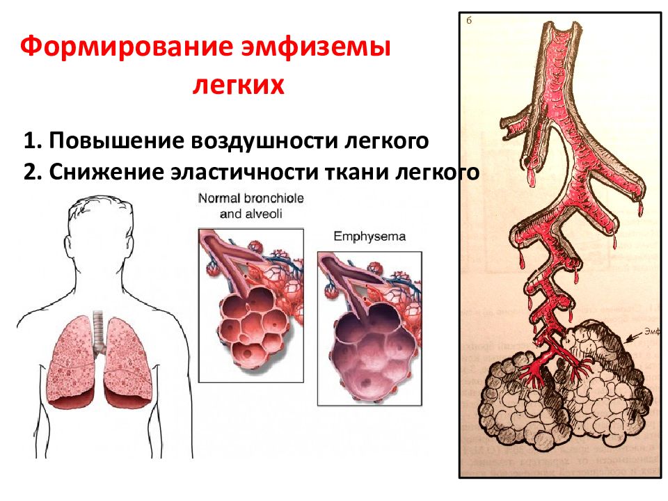 1 эмфизема легких