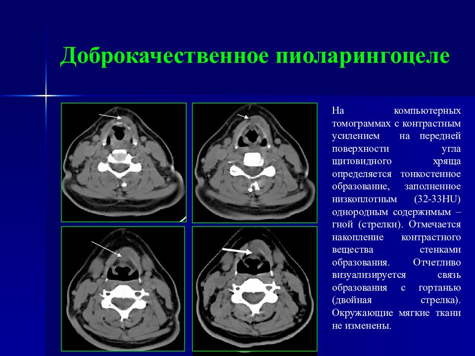 Контрастное кт. Накопление контрастного вещества при кт. Накопление контраста на кт. Кт с контрастным усилением. Фронтальная поверхность на кт.