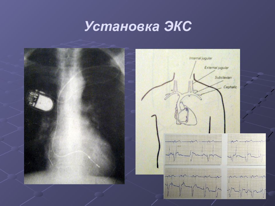 Аритмии и блокады сердца презентация