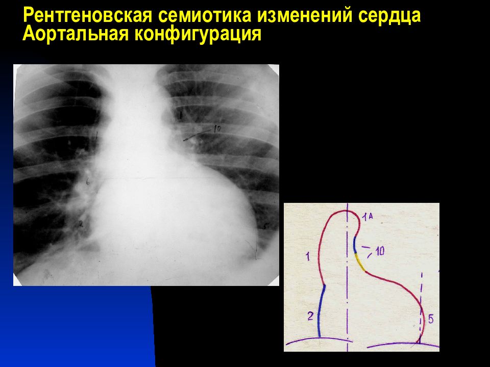 Трапециевидное сердце. Трапециевидная конфигурация сердца. Трапециевидная конфигурация сердца на рентгенограмме. Аортальное сердце на рентгене. Трапециевидное сердце на рентгене.