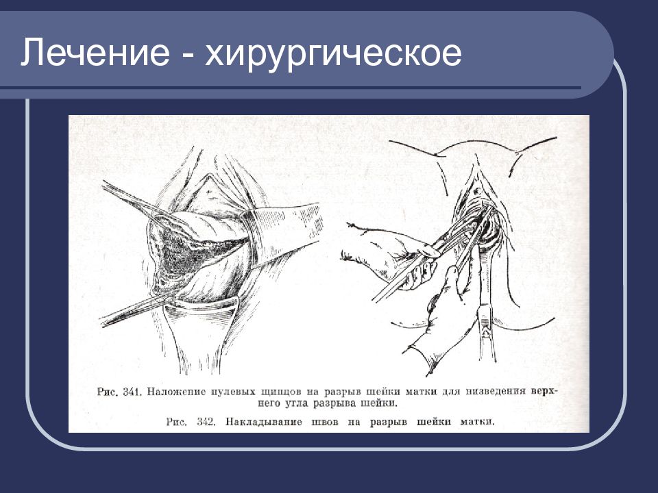 Акушерский травматизм презентация