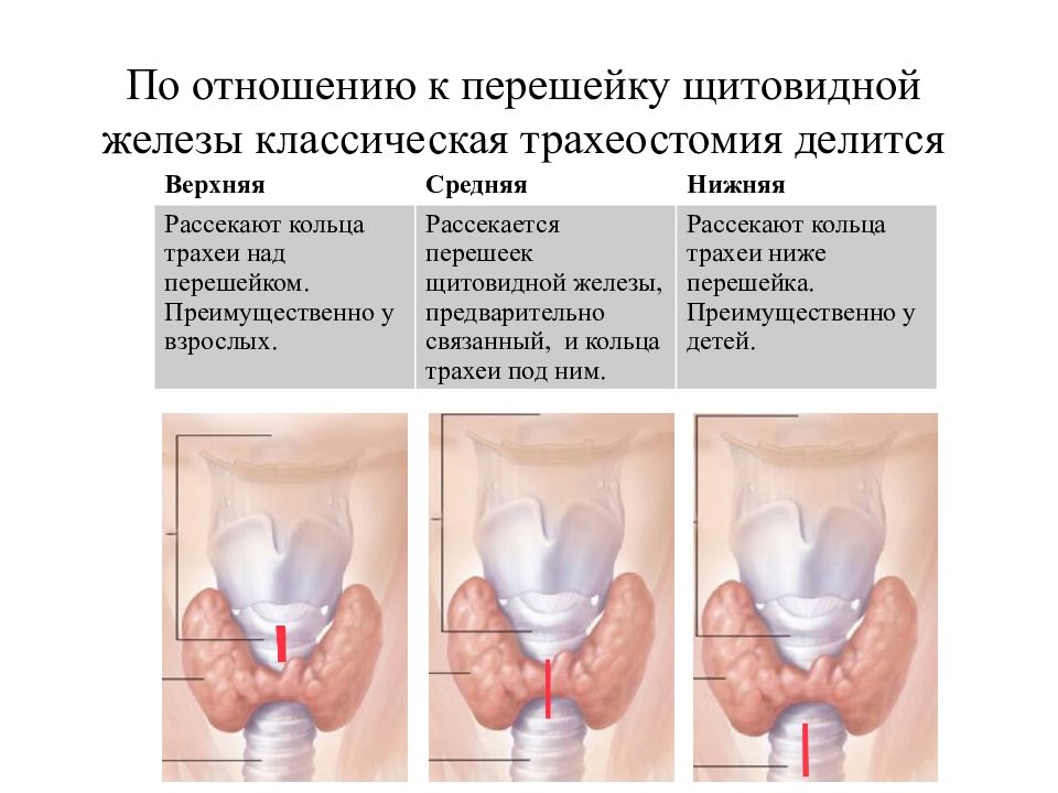 Трахеостомия у взрослых