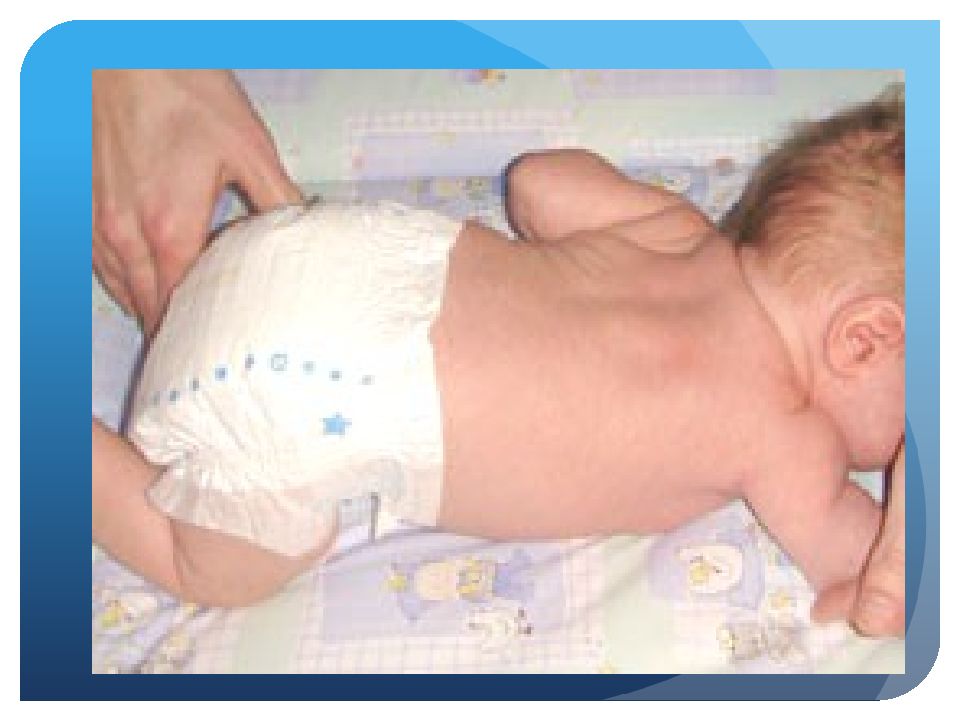 Дцп у грудничка. Церебральная форма головы у новорожденного. ДЦП У новорожденных фото. Дитячий церебральний параліч у новонароджених.
