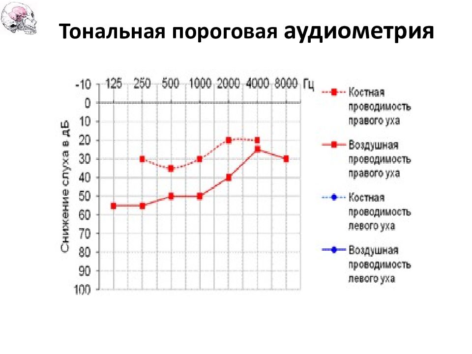 Аудиометрия это. Тональная пороговая и надпороговая аудиометрия. Надпороговая тональная аудиометрия диаграммы. Тональная пороговая аудиограмма при болезни Меньера. Тональная пороговая аудиометрия импедансометрия норма.