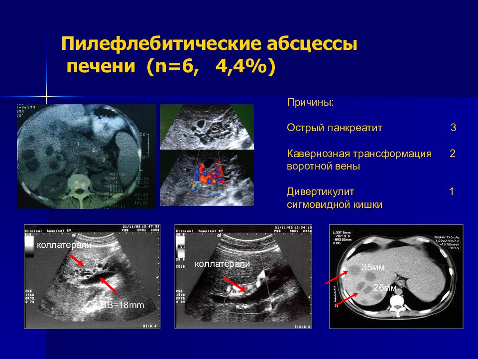 Признаки абсцесса печени на т1 взвешенных изображениях