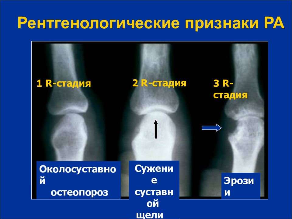 Для начального периода рахита характерна следующая рентгенологическая картина