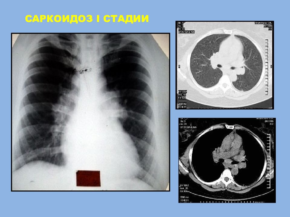 Саркоидоз фтизиатрия презентация