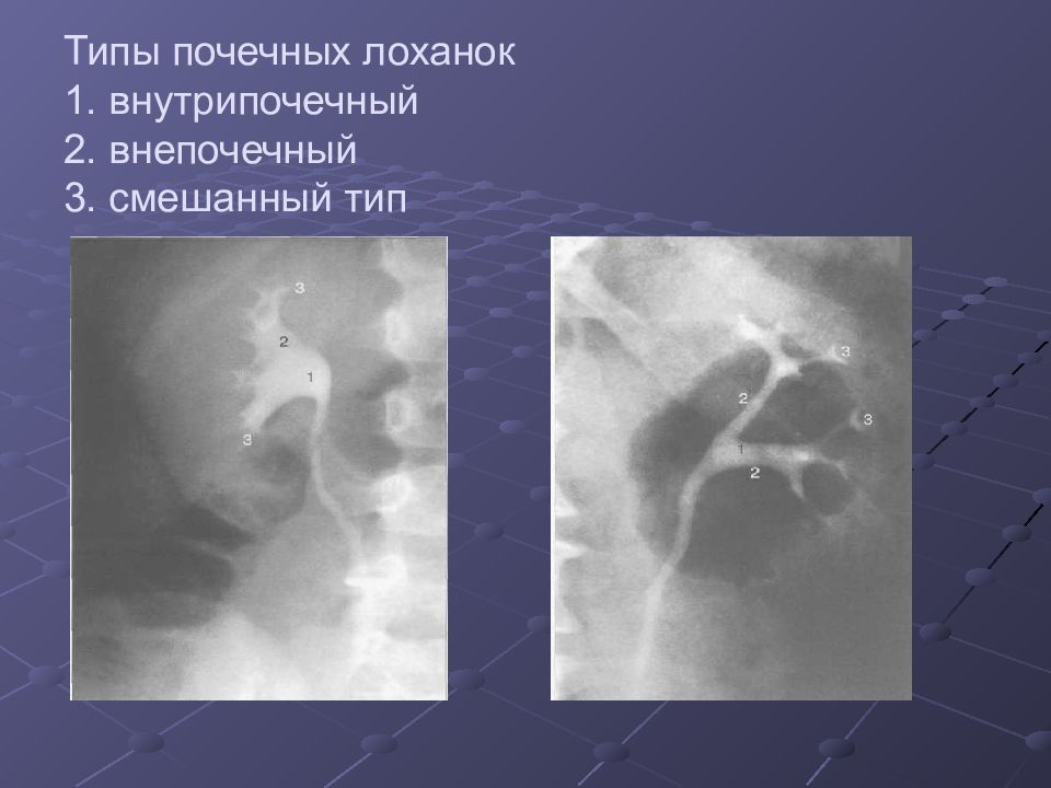 Лучевая диагностика почек презентация