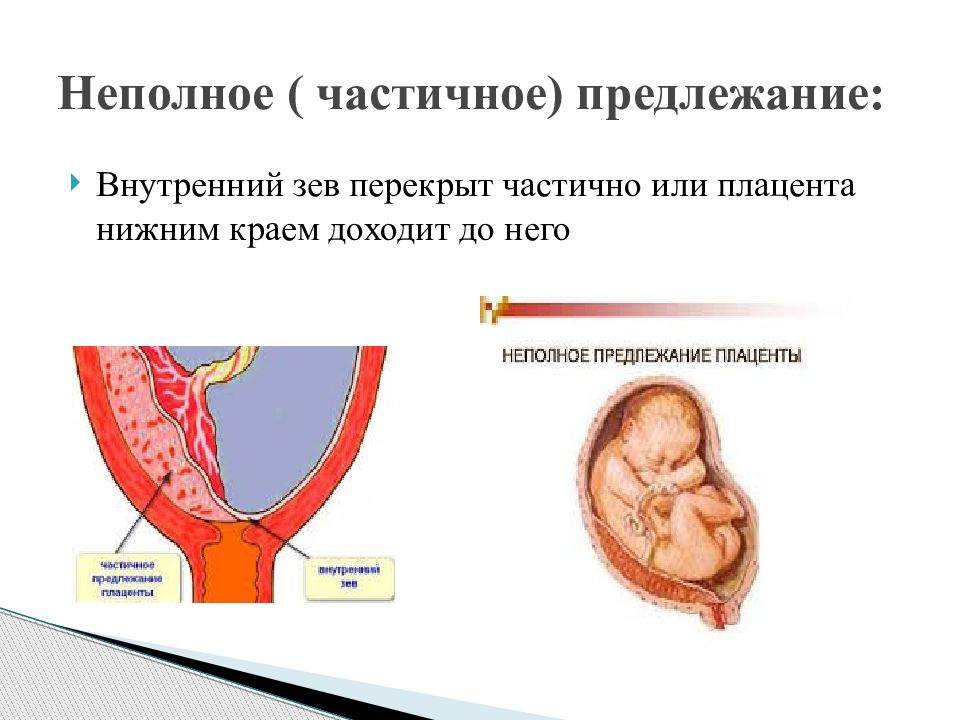 Предлежание плаценты презентация