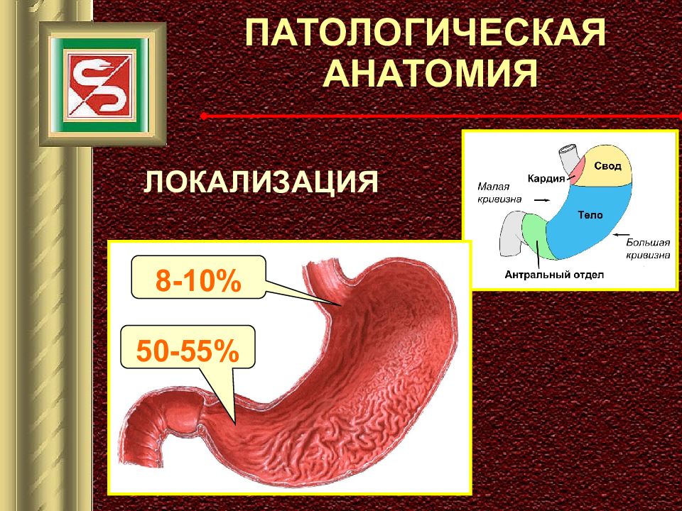 Рак желудка патанатомия презентация