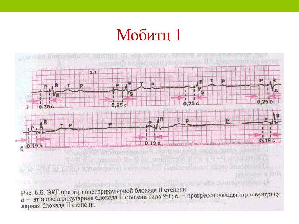 Экг 1. Атриовентрикулярная блокада Мобиц 1 ЭКГ. АВ блокада 2 степени Мобитц 3. ЭКГ атриовентрикулярная блокада Мобитц 2. Атриовентрикулярная блокада Мобитц 1 на ЭКГ.