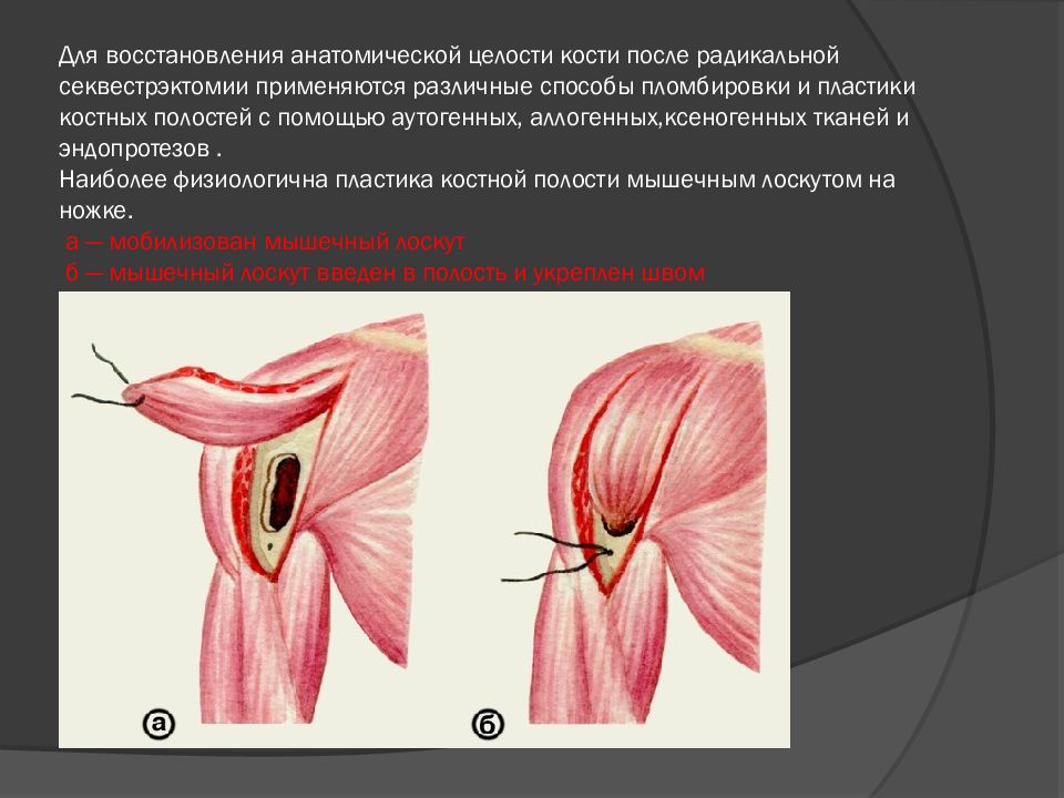 Секвестрэктомия ход операции. Секвестрэктомия челюсти. Секвестрэктомия этапы. Секвестрэктомия при остеомиелите методика проведения.