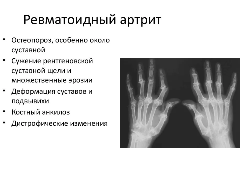 Ревматический полиартрит рентгенологическая картина