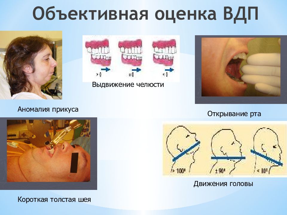Степени открывания рта классификация. Методы исследования движений нижней челюсти. Степень открывания рта. Степень открывания рта степени. Открывание рта в норме.