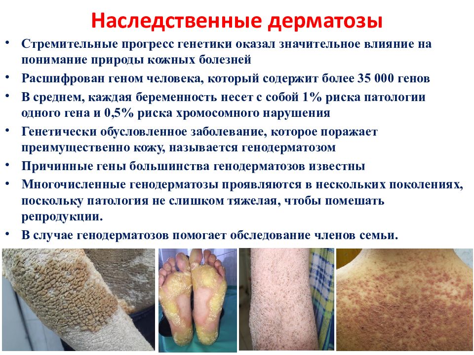 Наследственные дерматозы