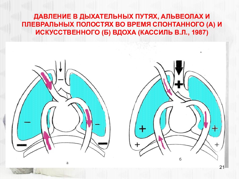 Давление в плевральной полости. Давление в дыхательных путях. Среднее давление в дыхательных путях. Пиковое давление в дыхательных путях. Пиковое давление в дыхательных путях ИВЛ.