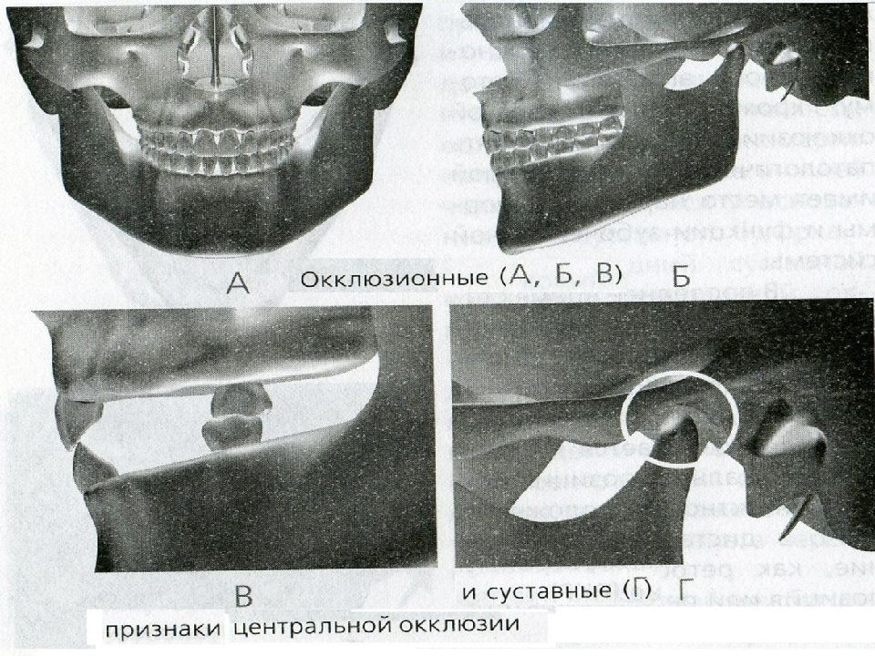 Центральная окклюзия и центральное соотношение челюстей презентация