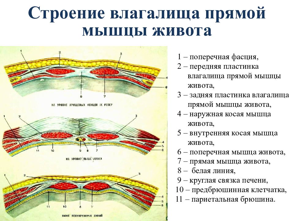 Поперечный распил передней брюшной стенки выше и ниже пупка схема