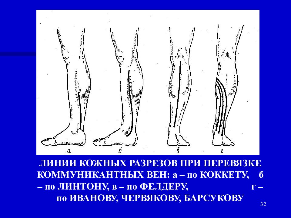 Перевязка подкожных вен. Методы перевязки коммуникантных вен. Операция Линтона Фельдера. Подфасциальная перевязка перфорантных вен. Перевязка несостоятельных перфорантных вен.