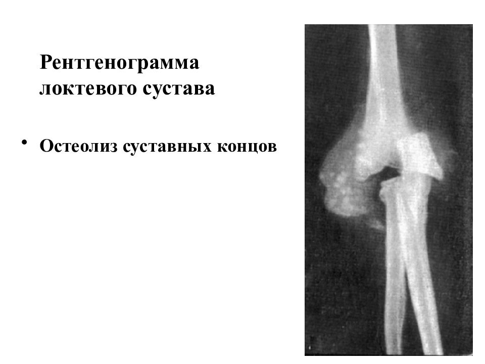 Остеолиз это. Остеолиз рентген признаки. Рентгенограмма локтевого сустава. Остеолиз локтевого сустава. Остеолиз плечевого сустава.