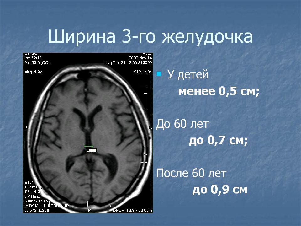 Нормы размеров желудочков головного мозга. Третий желудочек головного мозга мрт. Третий желудочек головного мозга кт норма. Расширение желудочков головного мозга у детей на кт. Желудочки головного мозга на кт.