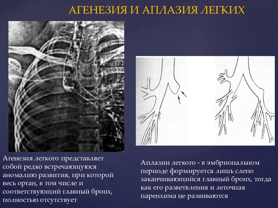 Агенезия венозного. Агенезия и аплазия легкого. Агенезия легкого рентгенограмма. Агенезия (аплазия) бронхов. Аплазия легкого у детей клинические рекомендации.