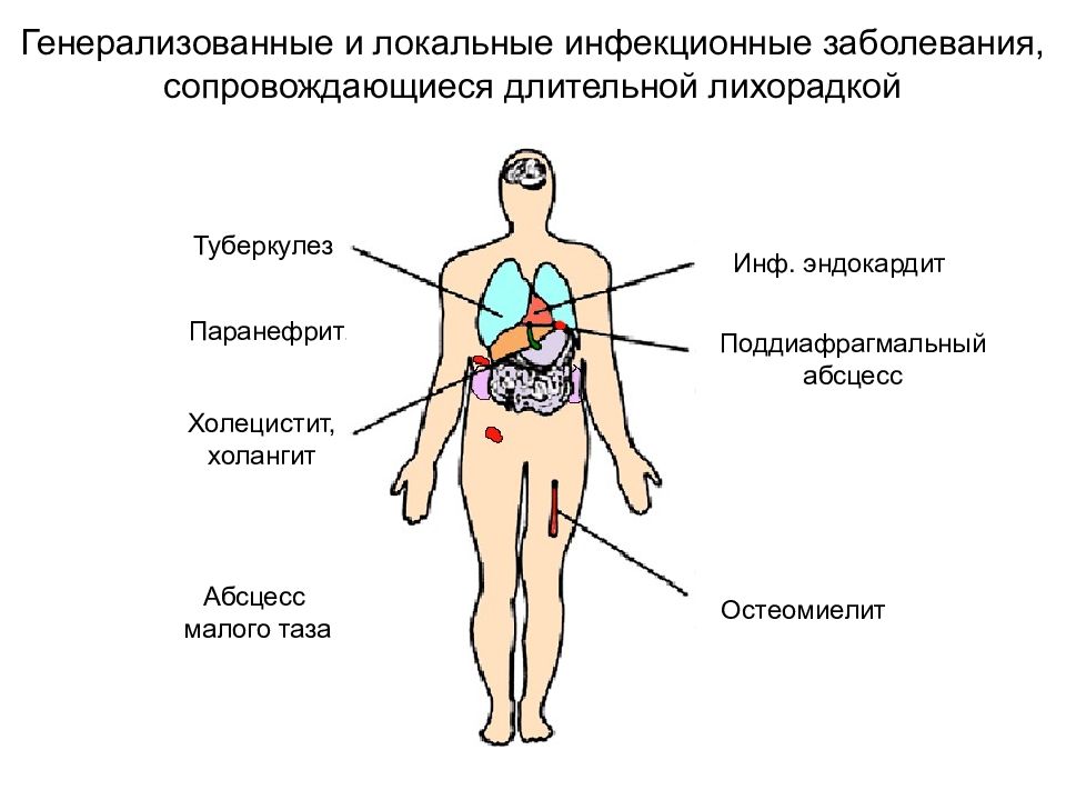 Укажите неправильное утверждение клиническая картина ку лихорадки характеризуется