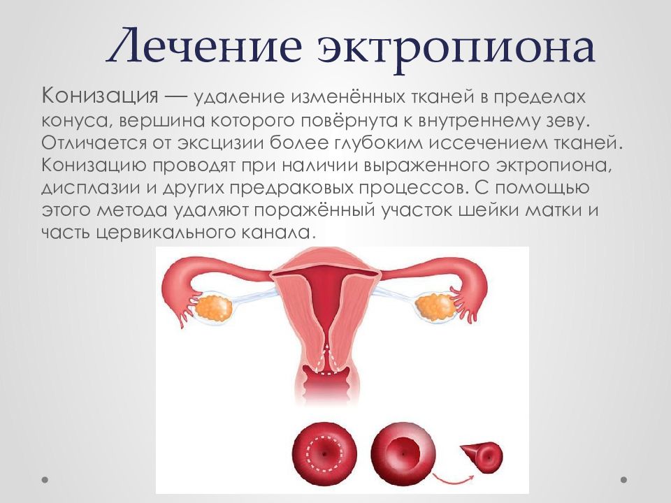 Эктропион шейки матки лечение