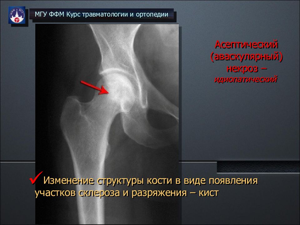 Асептический некроз стопы. Аваскулярный некроз головки плечевой кости рентген. Разряжение костной структуры. Участок разряжения костной структуры. Идиопатический асептический некроз кости.