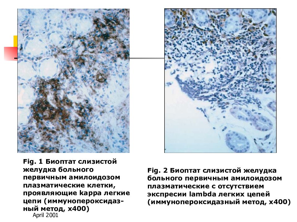 Биоптат слизистой желудка. Биоптат почки амилоидоз. Первичный амилоидоз легких. Амилоидоз желудочно-кишечного тракта.