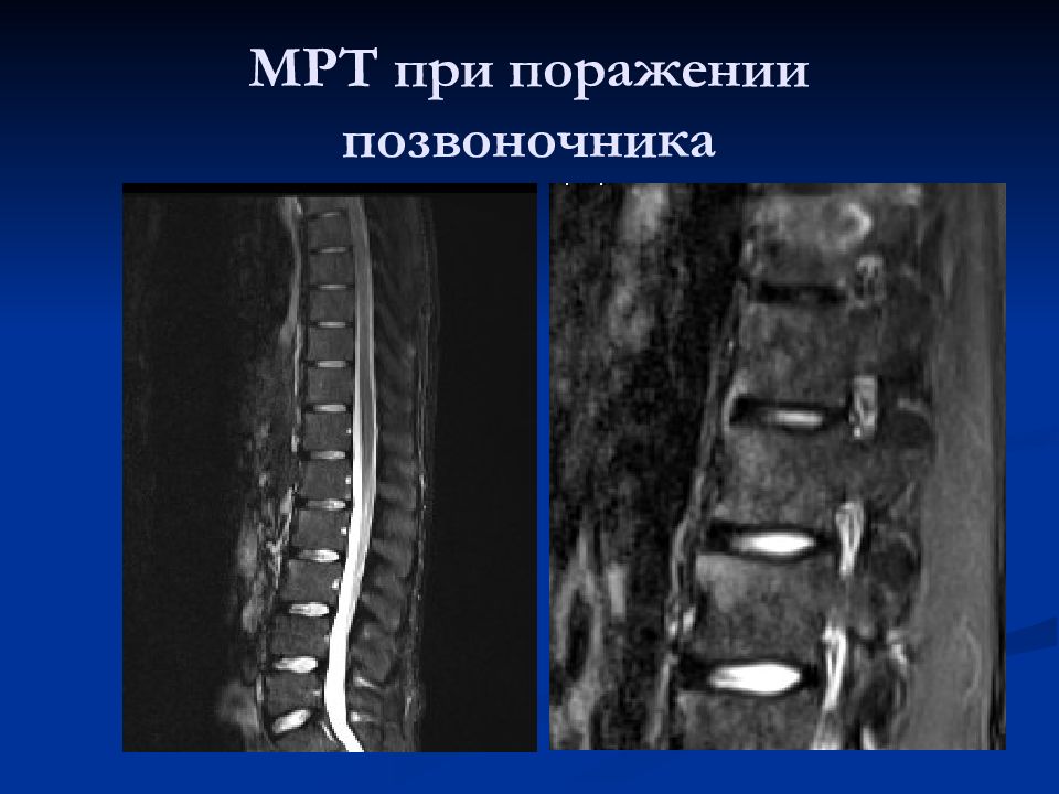 Лучевая диагностика позвоночник презентация